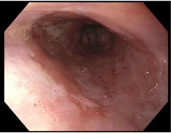 Endoscopy image from lower third of the esophagus showing salmon-colored mucosa and no visible lesions