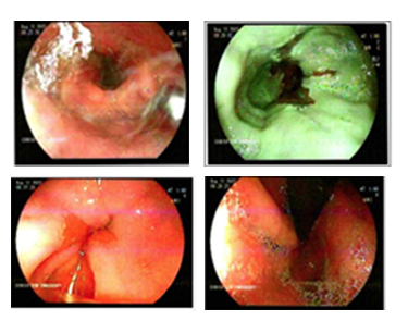 Endoscopy image from lower third of the esophagus showing salmon-colored mucosa and no visible lesions