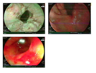 Endoscopy image from lower third of the esophagus showing salmon-colored mucosa and no visible lesions