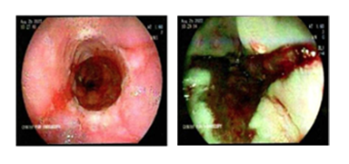 Endoscopy image from lower third of the esophagus showing salmon-colored mucosa and no visible lesions