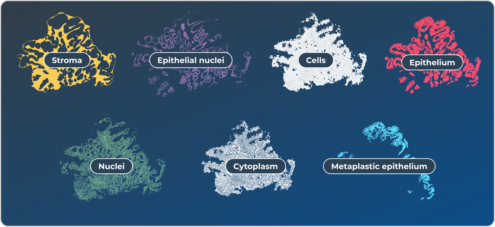 Stroma, Epithelial nuclei, Cells, Epithelium, Nuclei, Cytoplasm, Metaplastic epithelium