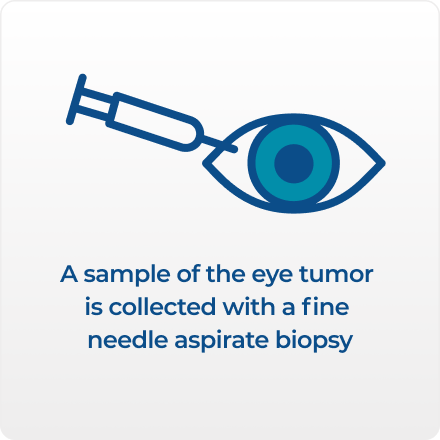 A sample from an eye is collected with a fine needle aspirate biopsy